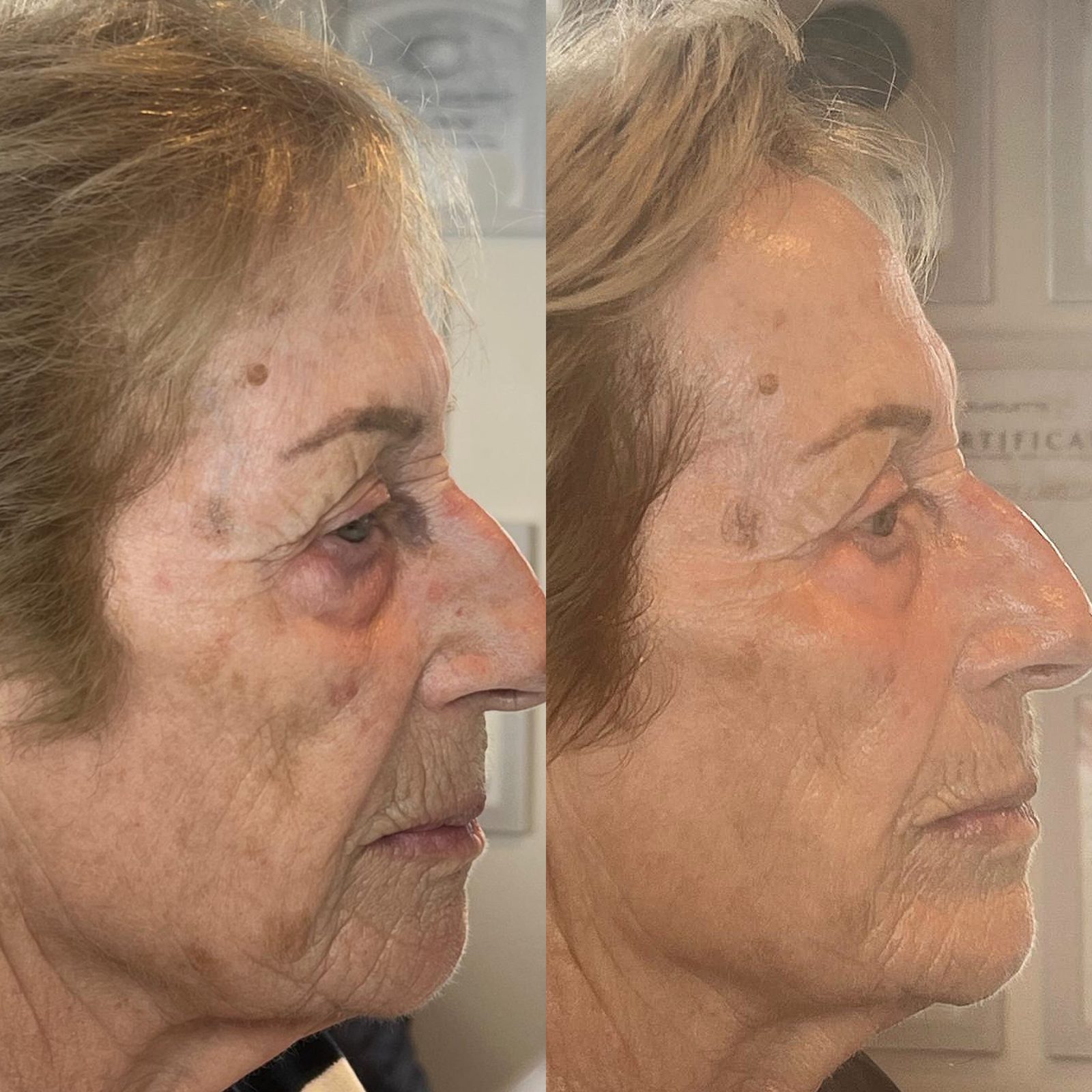 Warm Plasma before and after