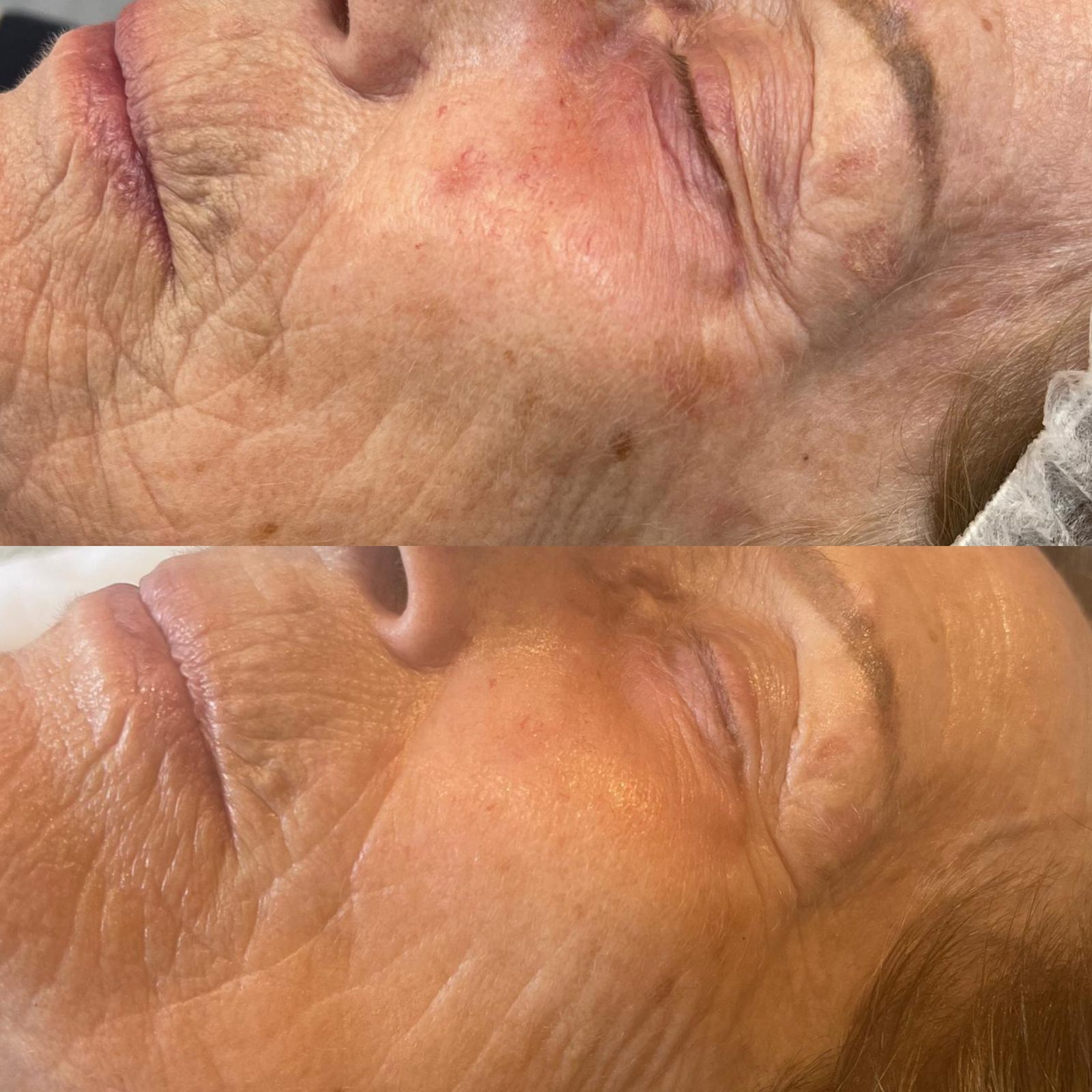 Warm Plasma before and after