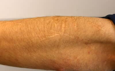 Healing Through Understanding: Navigating the Reality of Self-Harm Scars