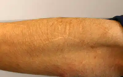 Healing Through Understanding: Navigating the Reality of Self-Harm Scars