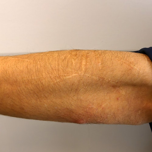 Self Harm Scar Treatment Perth