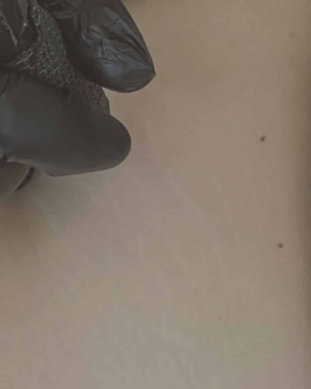 A gloved hand is shown pressing against a light-colored surface with a small mole visible nearby.