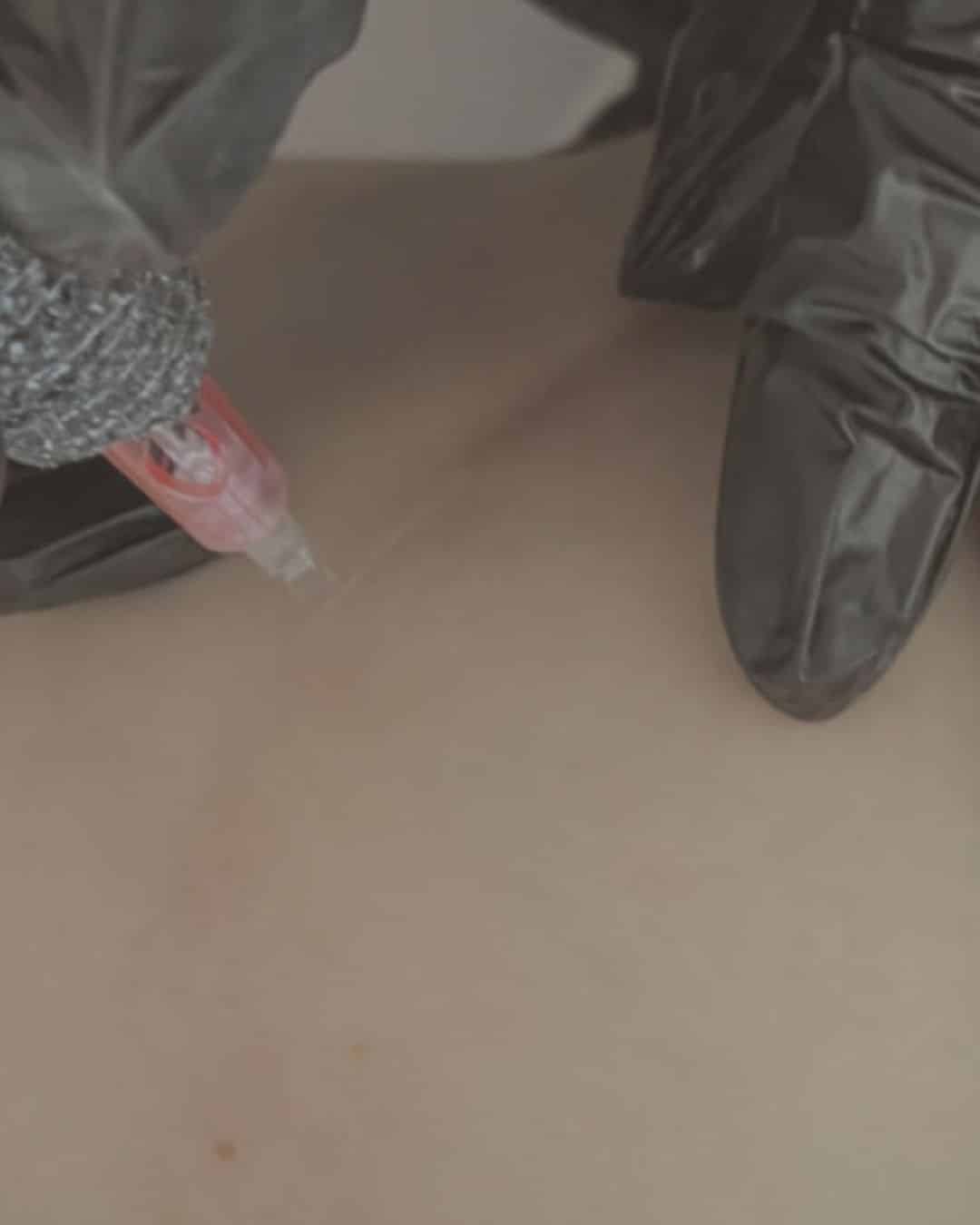 A close-up of gloved hands injecting a needle into the skin near a faint scar.