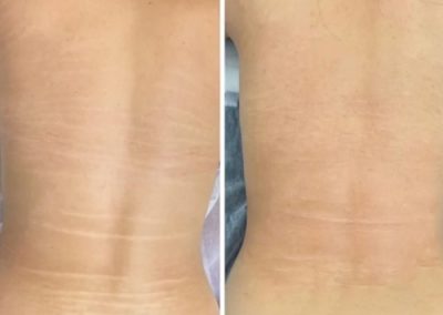 Side-by-side comparison of a person's back showing stretch marks on the left and visibly reduced stretch marks on the right. I Stretch Mark & Scar Treatment Perth Clinic