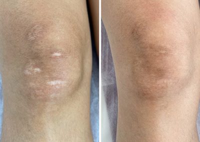 Close-up of two knees side by side, both showing areas of healed, light-colored scars on the skin. I Stretch Mark & Scar Treatment Perth Clinic