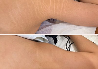 A person’s upper arm and armpit area shown in two images; the top shows visible stretch marks, while the bottom shows reduced appearance of stretch marks. I Stretch Mark & Scar Treatment Perth Clinic