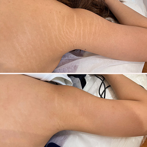 A person’s upper arm and armpit area shown in two images; the top shows visible stretch marks, while the bottom shows reduced appearance of stretch marks. I Stretch Mark & Scar Treatment Perth Clinic