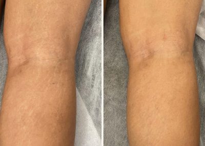 Side-by-side comparison of knees, showing reduced visibility of scars or discoloration on the right side compared to the left. I Stretch Mark & Scar Treatment Perth Clinic