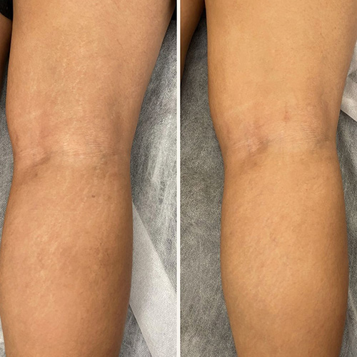 Side-by-side comparison of knees, showing reduced visibility of scars or discoloration on the right side compared to the left. I Stretch Mark & Scar Treatment Perth Clinic
