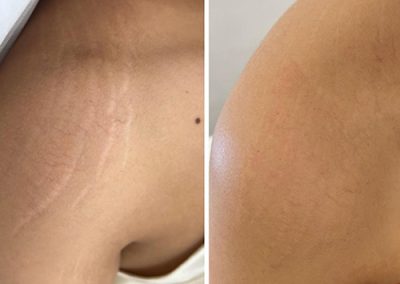 Side-by-side comparison of an upper arm before and after treatment, showing reduced appearance of stretch marks and smoother skin in the after image. I Stretch Mark & Scar Treatment Perth Clinic