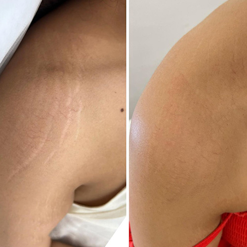 Side-by-side comparison of an upper arm before and after treatment, showing reduced appearance of stretch marks and smoother skin in the after image. I Stretch Mark & Scar Treatment Perth Clinic