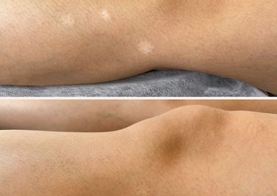 Two photos show a person's knee area; the top image has several white patches on the skin, while the bottom image shows the patches have faded or are less visible. I Stretch Mark & Scar Treatment Perth Clinic