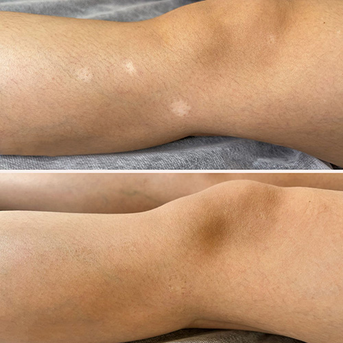 Two photos show a person's knee area; the top image has several white patches on the skin, while the bottom image shows the patches have faded or are less visible. I Stretch Mark & Scar Treatment Perth Clinic