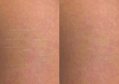 Side-by-side close-up of skin, showing stretch marks on the left and smoother skin with reduced marks on the right. I Stretch Mark & Scar Treatment Perth Clinic
