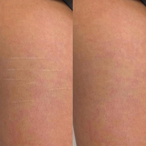 Side-by-side close-up of skin, showing stretch marks on the left and smoother skin with reduced marks on the right. I Stretch Mark & Scar Treatment Perth Clinic
