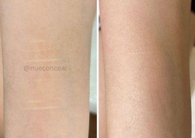 Side-by-side comparison of a forearm with visible stretch marks on the left, and the same arm with less visible marks on the right. I Stretch Mark & Scar Treatment Perth Clinic