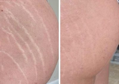 Side-by-side comparison of a person's hip and buttock showing visible stretch marks on the left and reduced appearance of stretch marks on the right. I Stretch Mark & Scar Treatment Perth Clinic