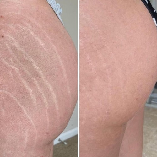 Side-by-side comparison of a person's hip and buttock showing visible stretch marks on the left and reduced appearance of stretch marks on the right. I Stretch Mark & Scar Treatment Perth Clinic
