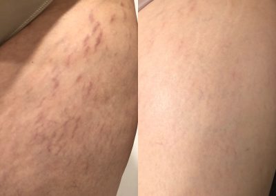 Side-by-side comparison of a person's upper thigh showing visible spider veins on the left and significantly reduced spider veins on the right. I Stretch Mark & Scar Treatment Perth Clinic
