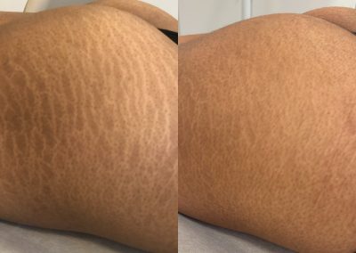 Side-by-side comparison of skin showing visible stretch marks on the left and smoother, less noticeable stretch marks on the right. I Stretch Mark & Scar Treatment Perth Clinic