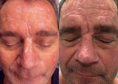Two close-up photos of a man's face with eyes closed, showing dry, flaky skin and redness, displayed side by side for comparison. I Stretch Mark & Scar Treatment Perth Clinic