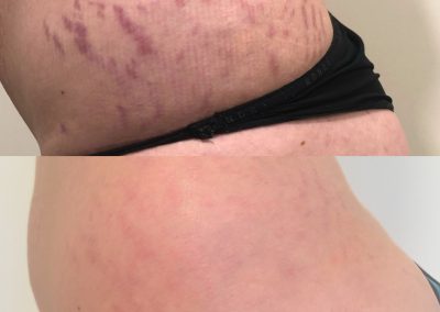 A side-by-side comparison of skin on a hip area; the top shows pronounced stretch marks, while the bottom shows faded stretch marks. I Stretch Mark & Scar Treatment Perth Clinic