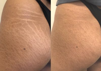 Side-by-side comparison of a person's upper thigh and hip showing stretch marks; the right image shows reduced appearance of stretch marks compared to the left. I Stretch Mark & Scar Treatment Perth Clinic