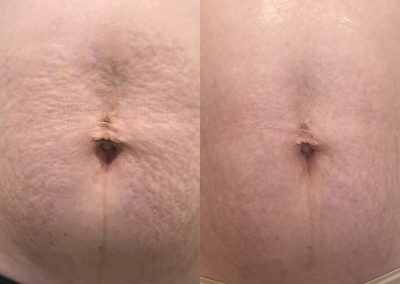 Close-up before-and-after comparison of abdominal skin, showing reduced stretch marks and smoother texture in the second image. I Stretch Mark & Scar Treatment Perth Clinic