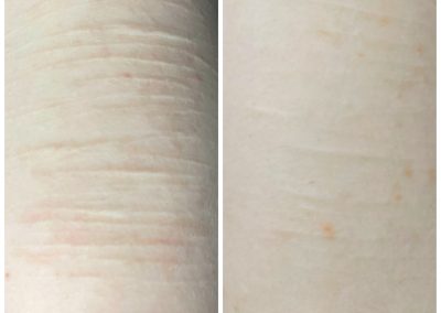 Side-by-side comparison of forearm skin showing fine lines and redness on the left, and smoother, less red skin on the right. I Stretch Mark & Scar Treatment Perth Clinic