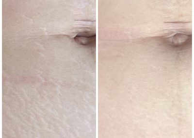 Side-by-side close-up of abdominal skin showing stretch marks and a small navel hernia, with reduced redness and smoother appearance on the right. I Stretch Mark & Scar Treatment Perth Clinic