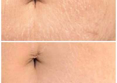 Two close-up images of a person's abdomen showing stretch marks; the top image shows more visible marks, while the bottom image shows marks that appear lighter and less noticeable. I Stretch Mark & Scar Treatment Perth Clinic
