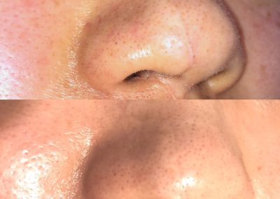 Close-up comparison of a nose before (top) and after (bottom) skincare treatment, showing a reduction in visible pores and improved skin texture. I Stretch Mark & Scar Treatment Perth Clinic