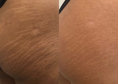 Side-by-side close-up of a person's upper thigh and buttock showing stretch marks; left side with more prominent marks, right side with reduced appearance. I Stretch Mark & Scar Treatment Perth Clinic