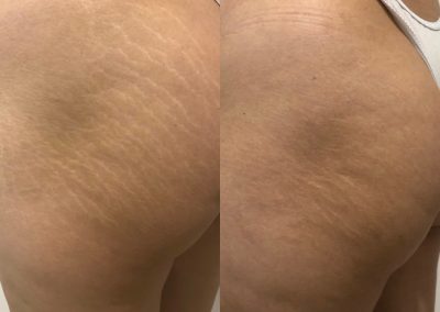 Side-by-side photos of the same person's hip and upper thigh showing visible stretch marks on the left and a smoother appearance with reduced stretch marks on the right. I Stretch Mark & Scar Treatment Perth Clinic