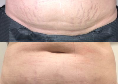 Two close-up images of an abdomen, showing stretch marks. The top image shows more pronounced marks, while the bottom image shows reduced marks and smoother skin. I Stretch Mark & Scar Treatment Perth Clinic