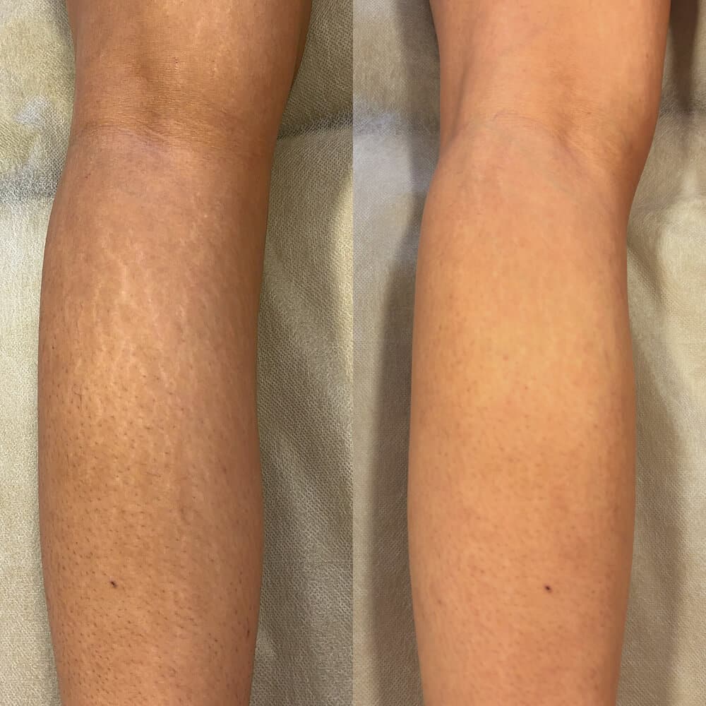 Side-by-side comparison of knees, showing reduced visibility of scars or discoloration on the right side compared to the left. I Stretch Mark & Scar Treatment Perth Clinic
