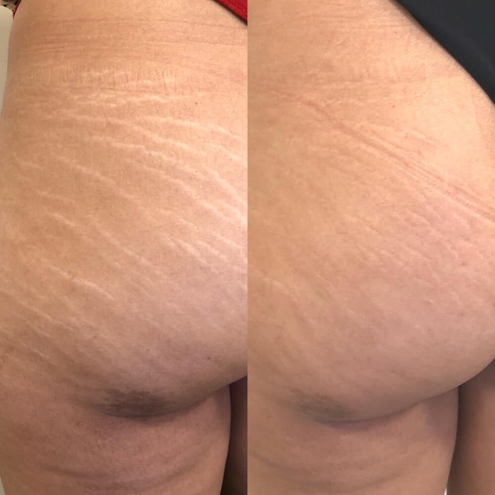 Two photos show a person's knee area; the top image has several white patches on the skin, while the bottom image shows the patches have faded or are less visible. I Stretch Mark & Scar Treatment Perth Clinic