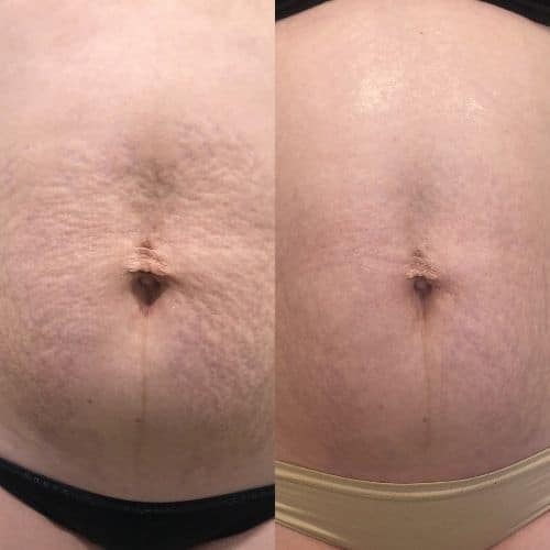 Close-up before-and-after comparison of abdominal skin, showing reduced stretch marks and smoother texture in the second image. I Stretch Mark & Scar Treatment Perth Clinic