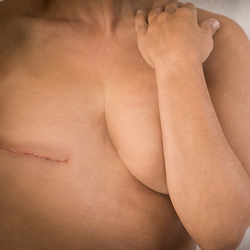 A person with a healing surgical scar on the left side of their chest, possibly following a mastectomy, holds their right shoulder.