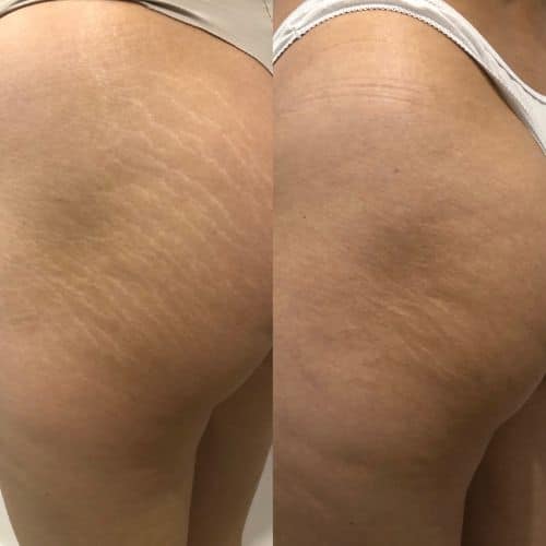 Side-by-side photos of the same person's hip and upper thigh showing visible stretch marks on the left and a smoother appearance with reduced stretch marks on the right. I Stretch Mark & Scar Treatment Perth Clinic