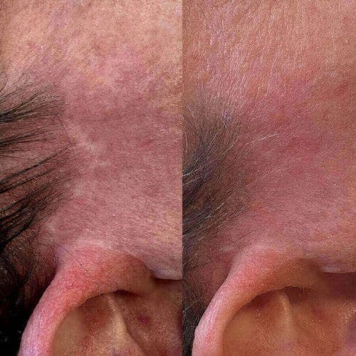 Side-by-side comparison of a person's upper thigh showing visible spider veins on the left and significantly reduced spider veins on the right. I Stretch Mark & Scar Treatment Perth Clinic