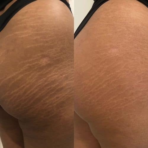 Side-by-side close-up of a person's upper thigh and buttock showing stretch marks; left side with more prominent marks, right side with reduced appearance. I Stretch Mark & Scar Treatment Perth Clinic