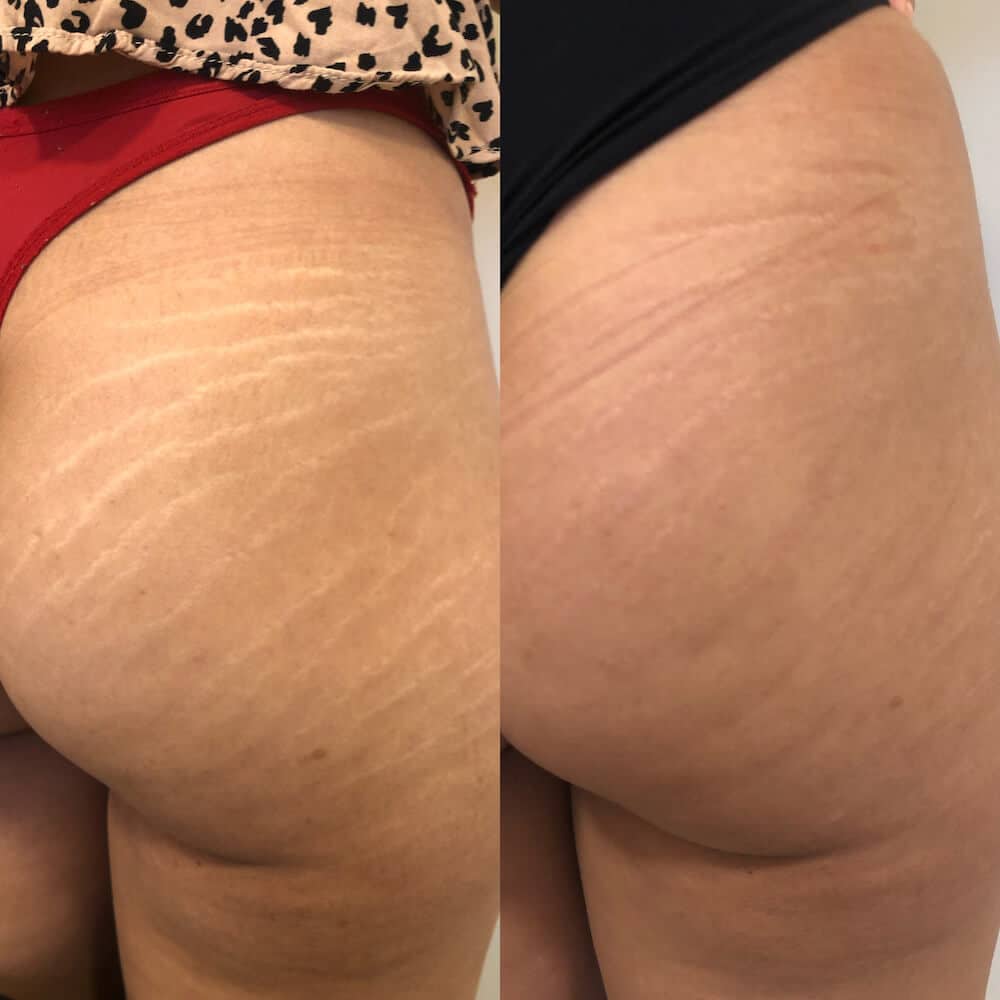 Side-by-side comparison of a person's upper thigh showing stretch marks; the left side shows more prominent marks, while the right side shows marks that are less visible. I Stretch Mark & Scar Treatment Perth Clinic