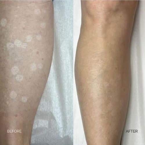 Side-by-side comparison of forearm skin showing fine lines and redness on the left, and smoother, less red skin on the right. I Stretch Mark & Scar Treatment Perth Clinic
