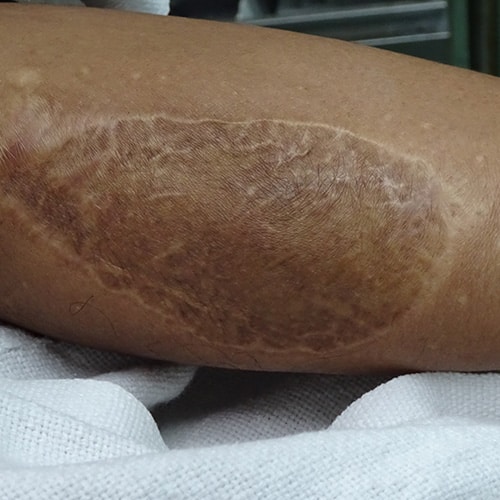 A close-up of a person's skin showing a large, oval-shaped, dark brown scar with a rough texture on their leg.
