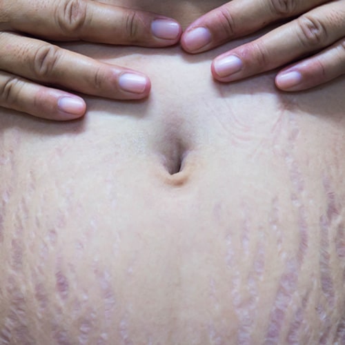 Close-up of a person's abdomen with visible stretch marks and hands resting above the navel.
