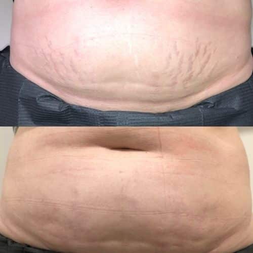 Two close-up images of an abdomen, showing stretch marks. The top image shows more pronounced marks, while the bottom image shows reduced marks and smoother skin. I Stretch Mark & Scar Treatment Perth Clinic