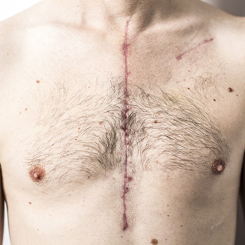 A person's bare chest showing a vertical surgical scar running from the upper chest down the middle, with smaller scars nearby and visible body hair.
