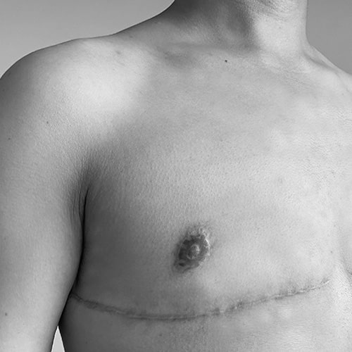 A person’s chest with a horizontal surgical scar below the pectoral muscles and a healing nipple, indicating post-surgical changes.