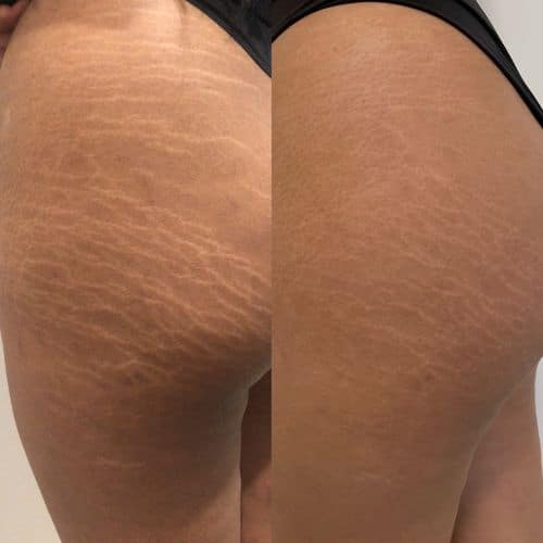 Close-up before-and-after comparison of abdominal skin, showing reduced stretch marks and smoother texture in the second image. I Stretch Mark & Scar Treatment Perth Clinic